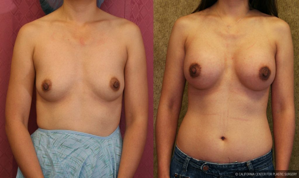 Breast Augmentation Before & After Patient #10436