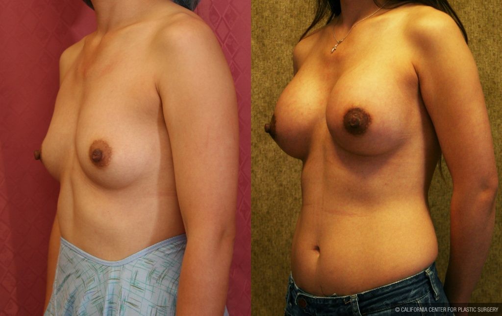 Breast Augmentation Before & After Patient #10436