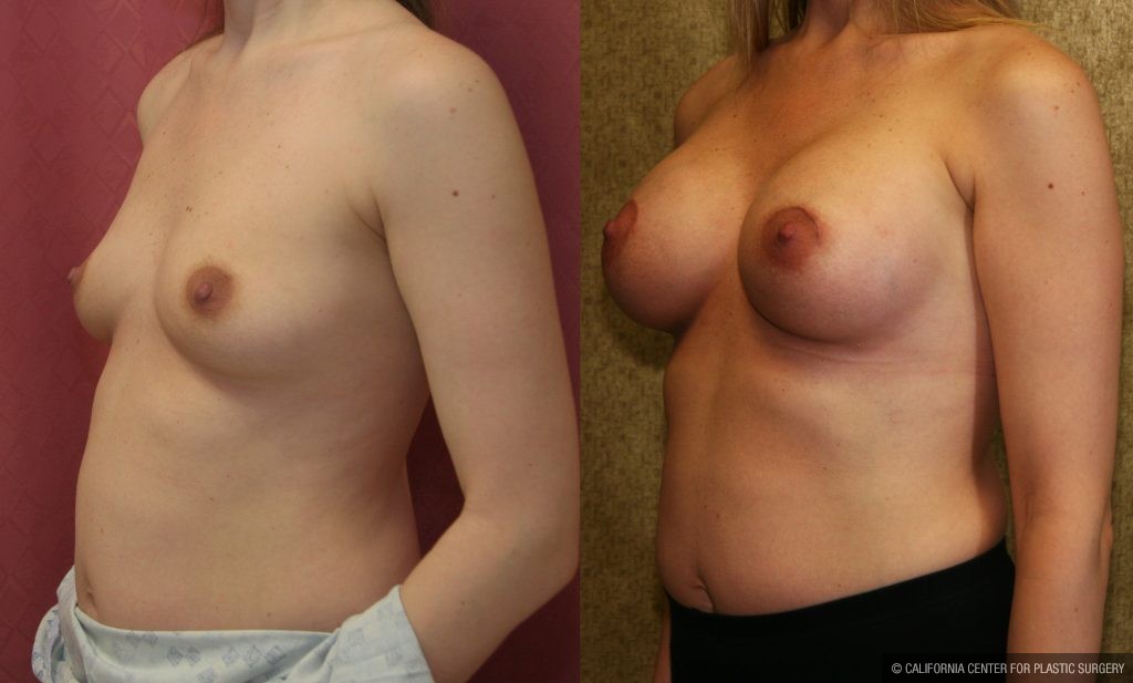 Breast Augmentation Before & After Patient #10275