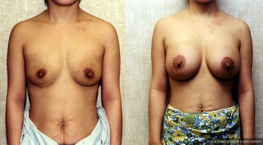 Breast Augmentation Before & After Patient #10422