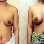 Breast Augmentation Before & After Patient #10422