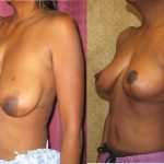 Breast Augmentation Before & After Patient #10440