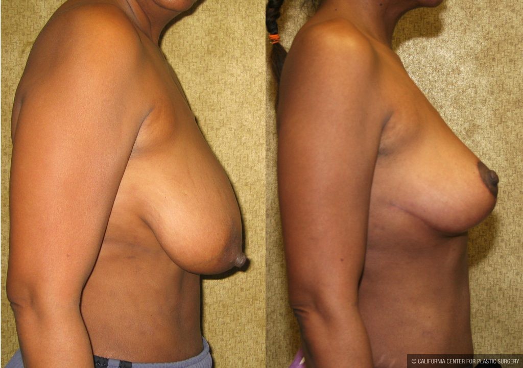 Breast Augmentation Before & After Patient #10440