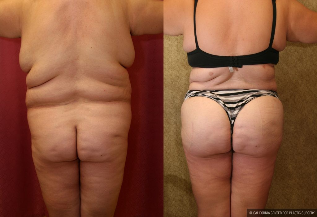 Body Contouring Before & After Patient #10419