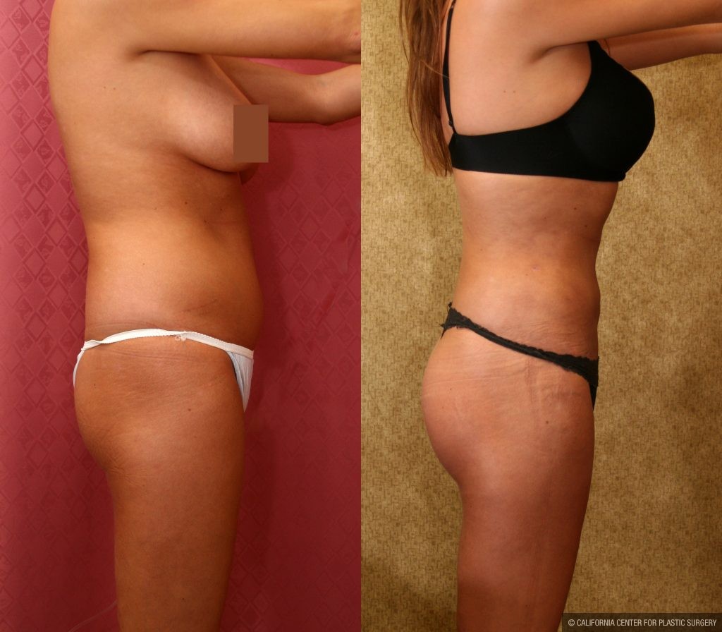 Body Contouring Before & After Patient #10407