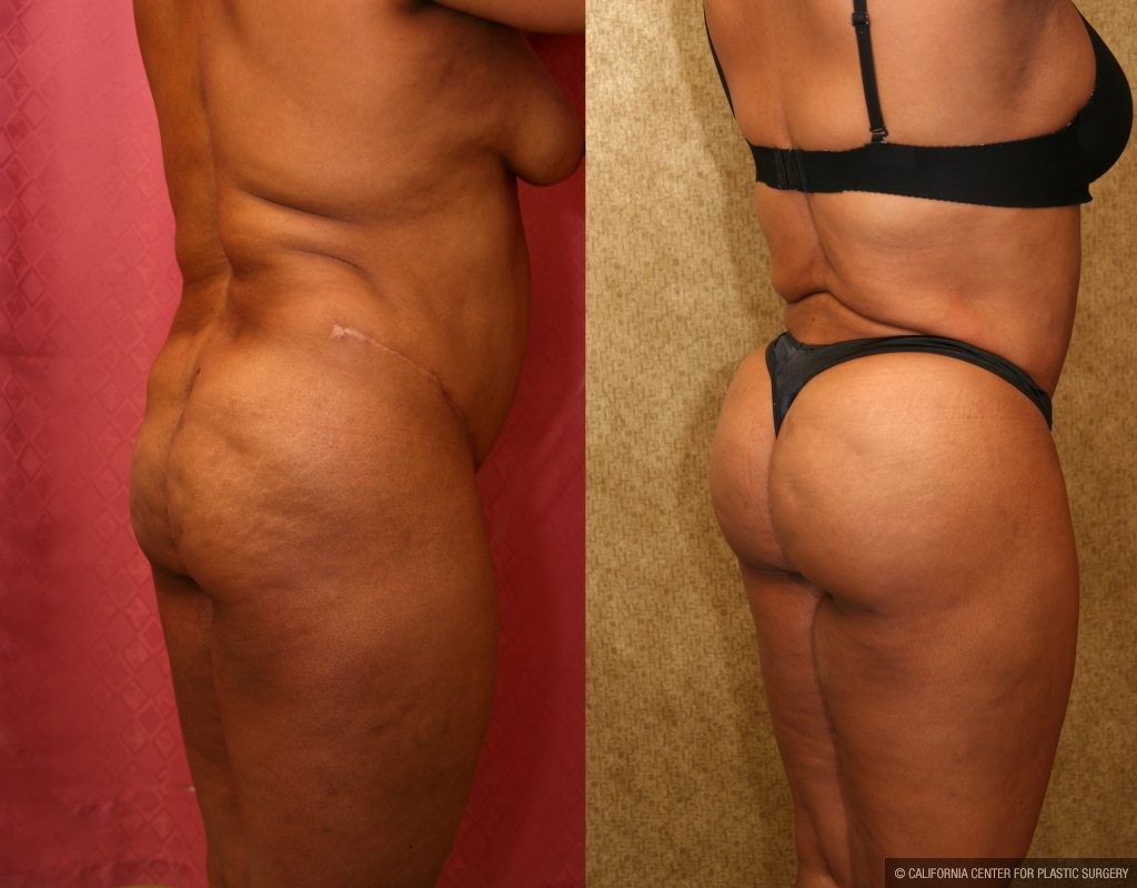 Body Contouring Before & After Patient #10413