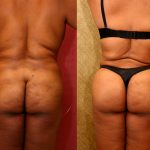 Body Contouring Before & After Patient #10413