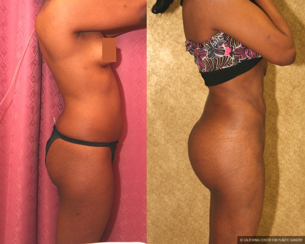 Body Contouring Before & After Patient #10404