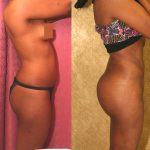 Body Contouring Before & After Patient #10404