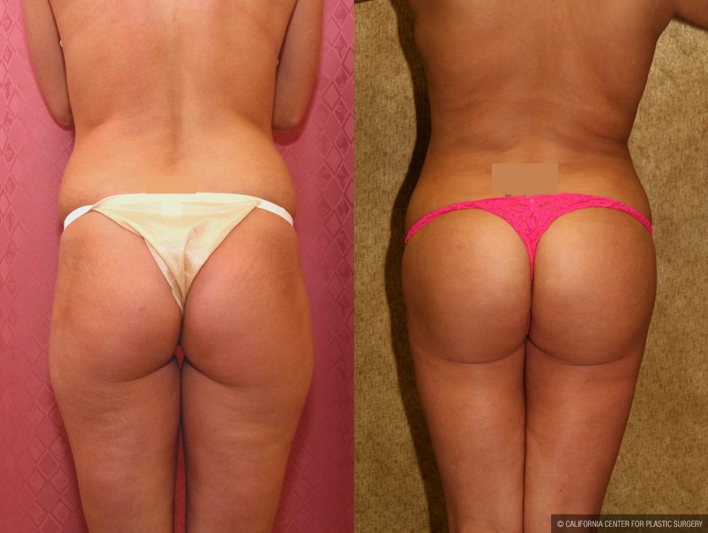 Body Contouring Before & After Patient #10416