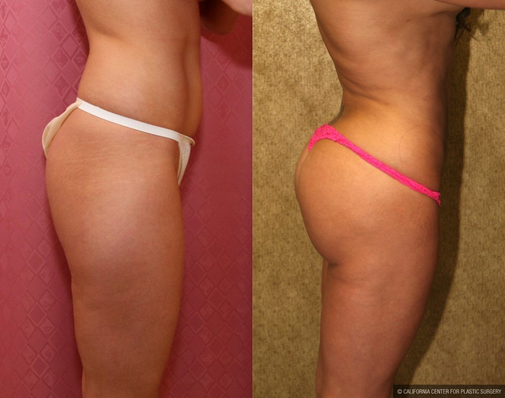 Body Contouring Before & After Patient #10416