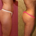 Body Contouring Before & After Patient #10416