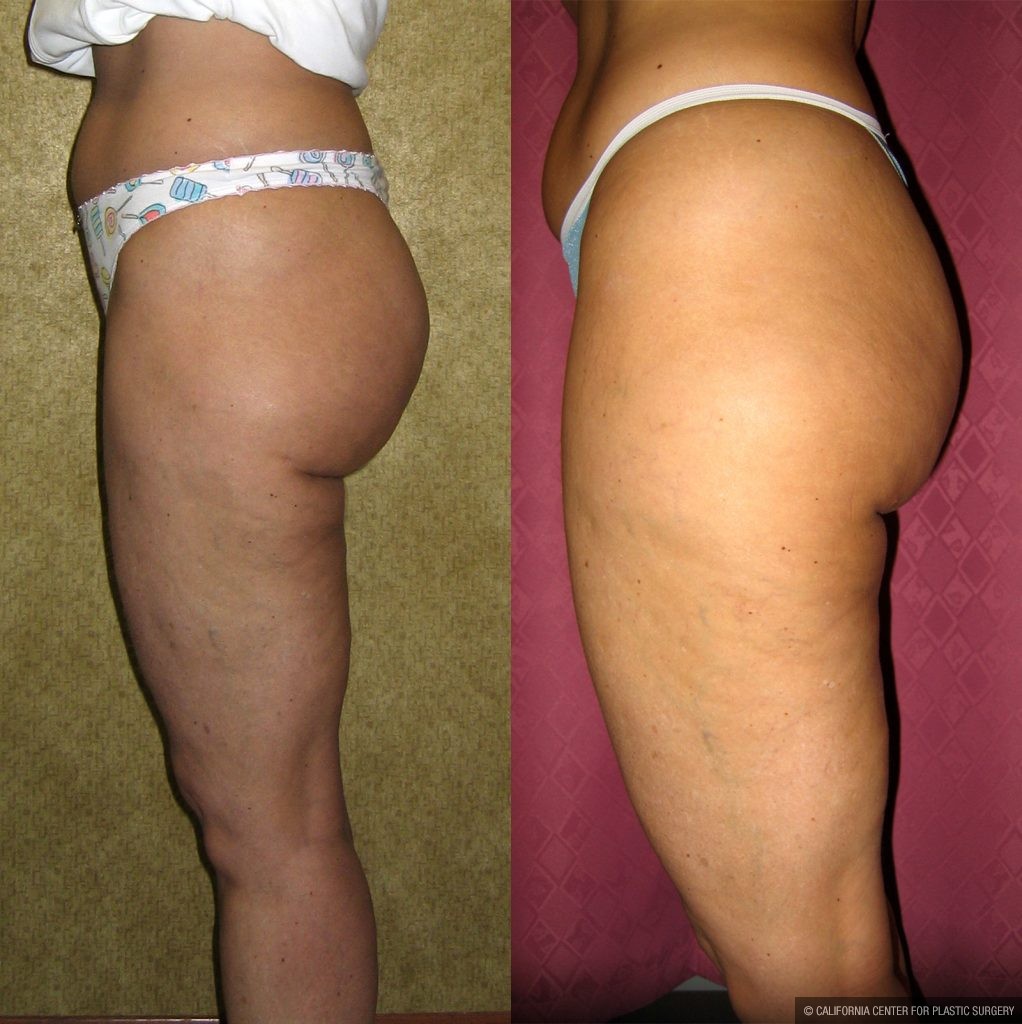 Body Contouring Before & After Patient #10336