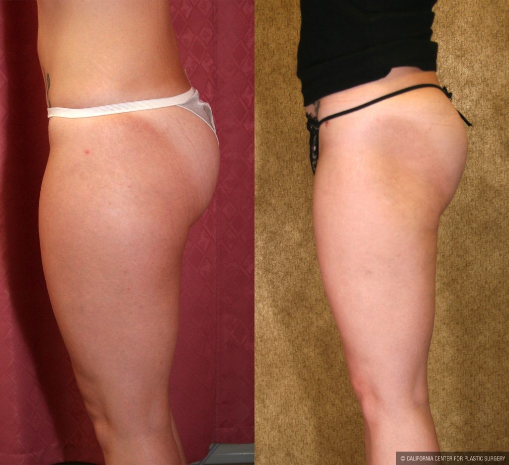 Body Contouring Before & After Patient #10327