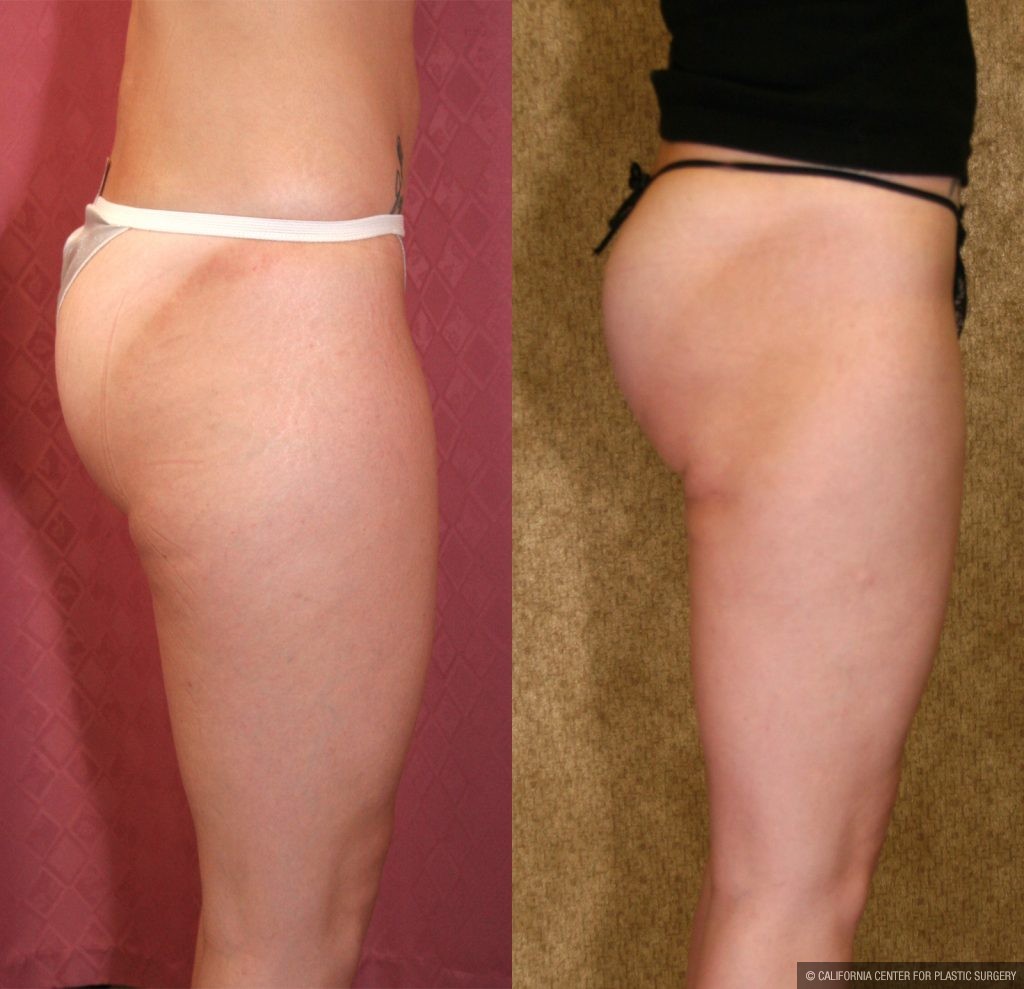 Body Contouring Before & After Patient #10327