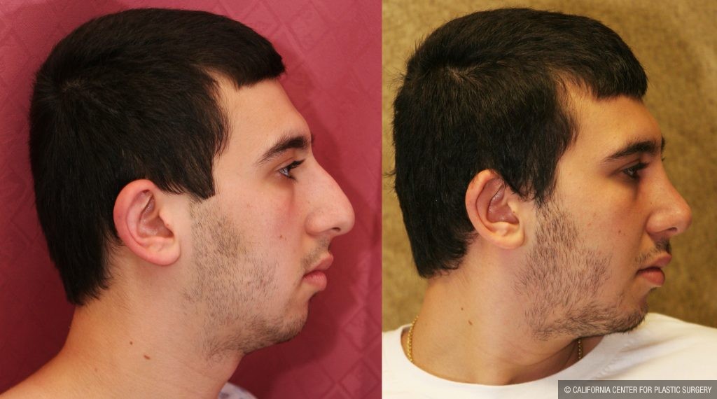 Male Rhinoplasty Before & After Patient #10449