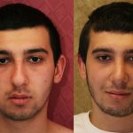 Male Rhinoplasty Before & After Patient #10449