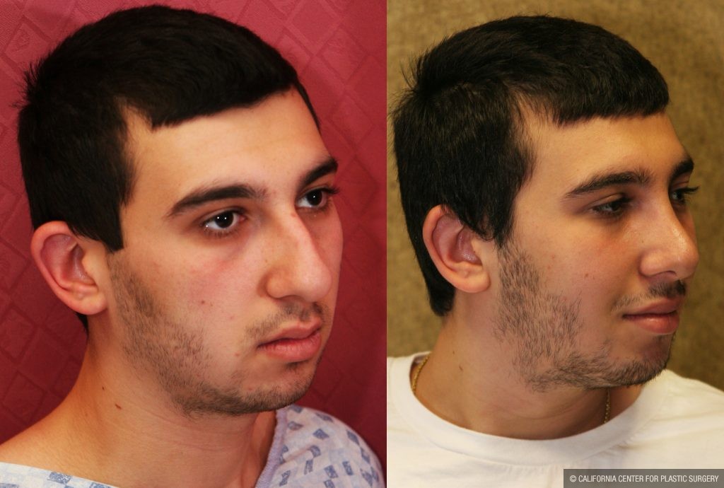 Male Rhinoplasty Before & After Patient #10449