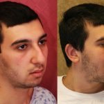 Male Rhinoplasty Before & After Patient #10449