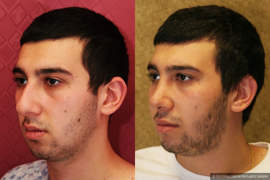 Male Rhinoplasty Before & After Patient #10449