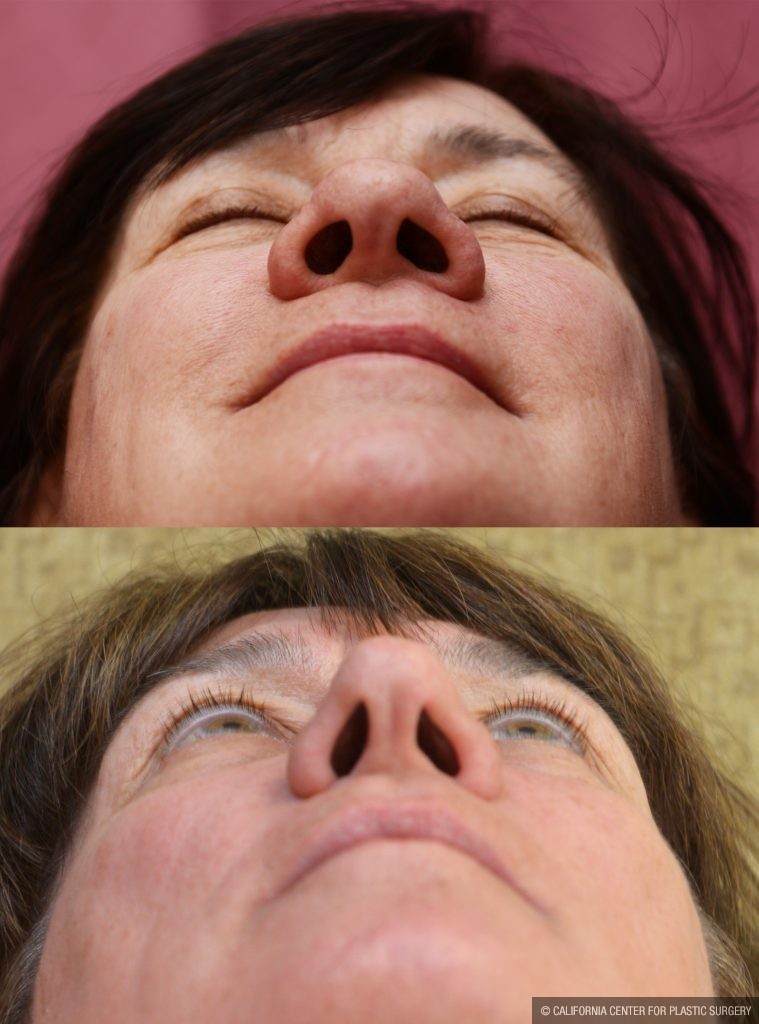 Rhinoplasty - Caucasian Before & After Patient #10444