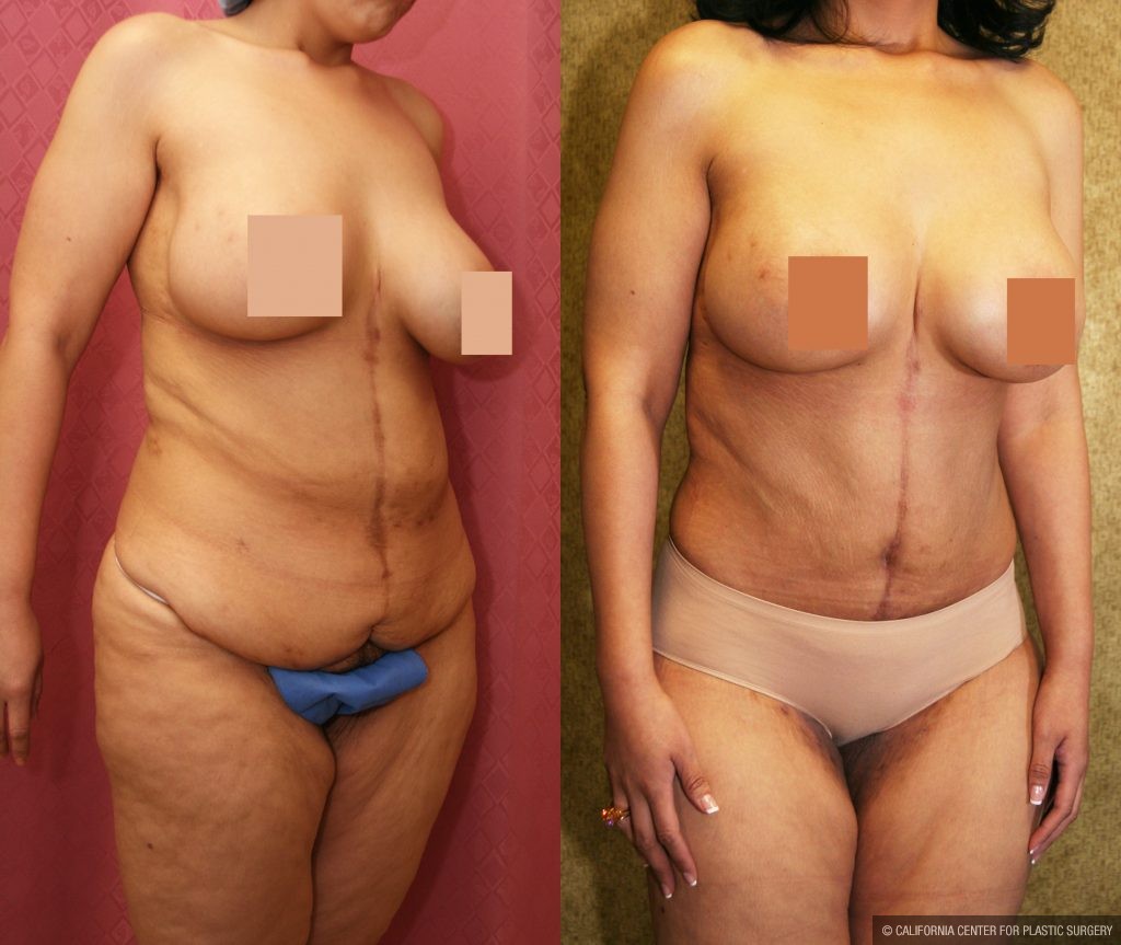 Body Contouring Before & After Patient #10400