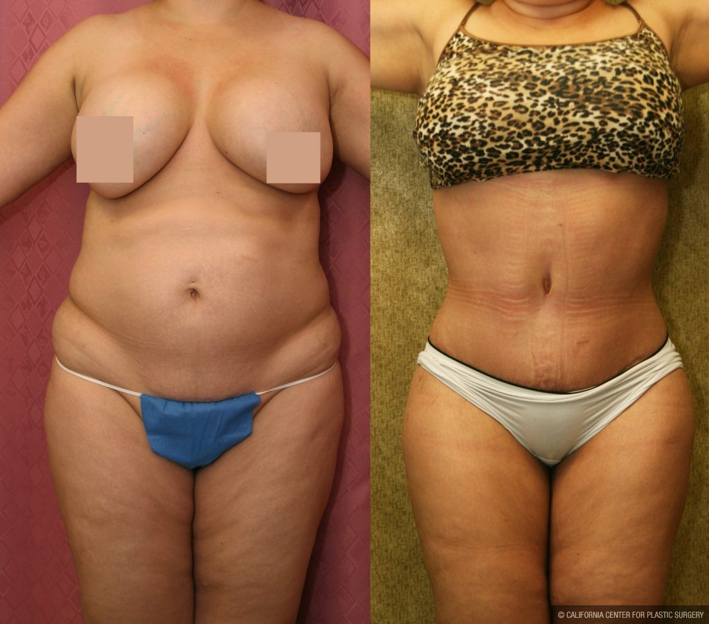 Body Contouring Before & After Patient #10350