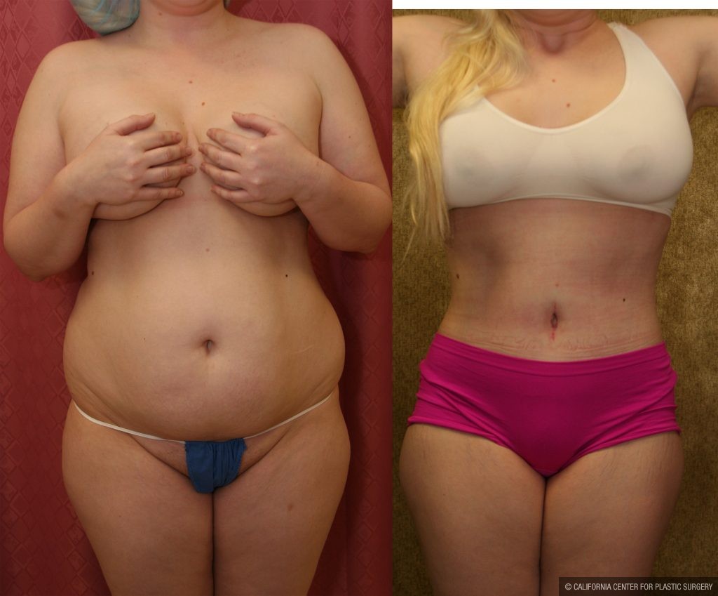 Body Contouring Before & After Patient #10346