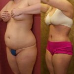 Body Contouring Before & After Patient #10346