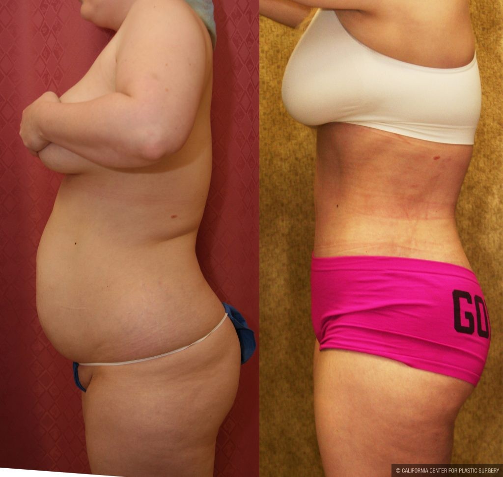 Body Contouring Before & After Patient #10346