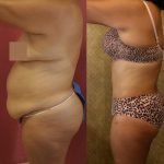 Body Contouring Before & After Patient #10396