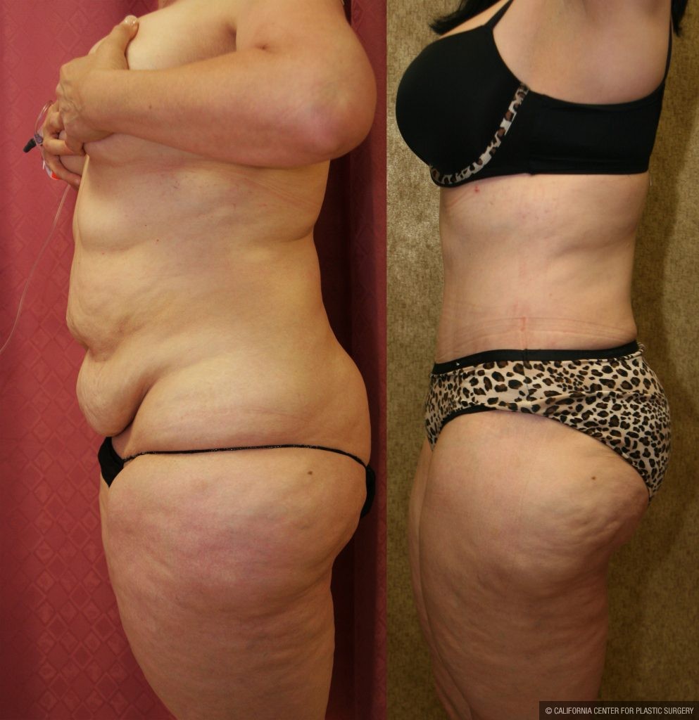 Body Contouring Before & After Patient #10290