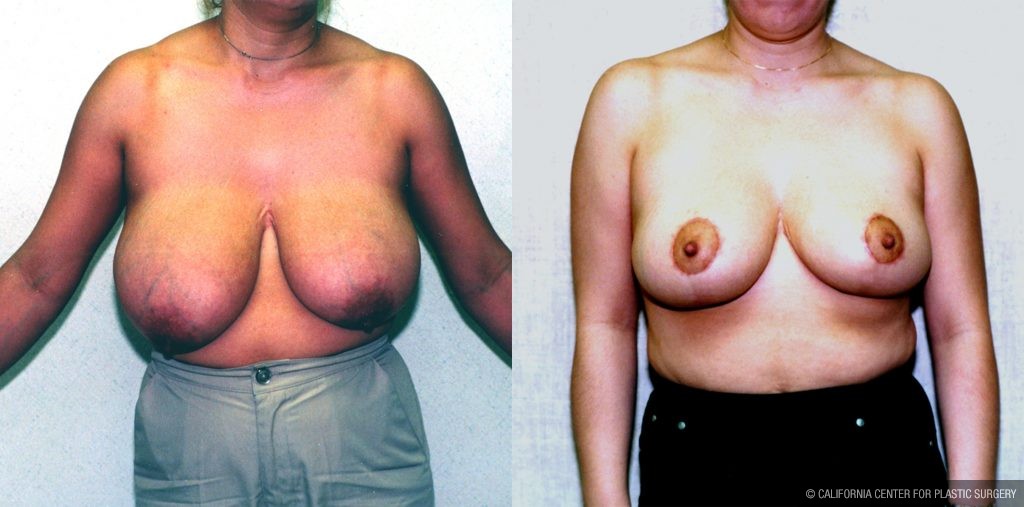 Breast Enhancement Before & After Patient #10489