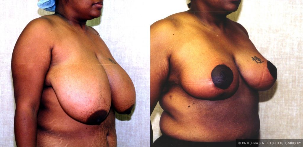 Breast Enhancement Before & After Patient #10493