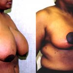 Breast Enhancement Before & After Patient #10493