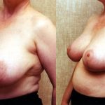 Breast Enhancement Before & After Patient #10496