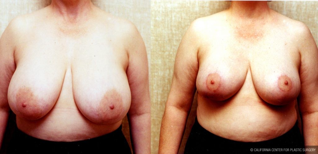 Breast Enhancement Before & After Patient #10496