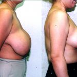 Breast Enhancement Before & After Patient #10489