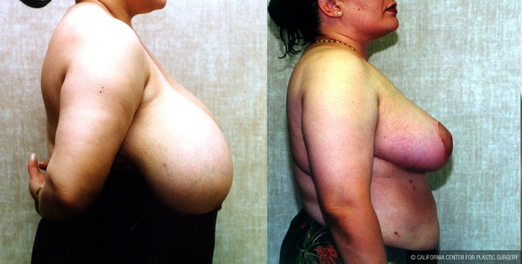 Breast Enhancement Before & After Patient #10499