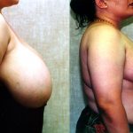 Breast Enhancement Before & After Patient #10499