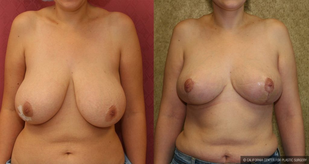 Breast Enhancement Before & After Patient #10502