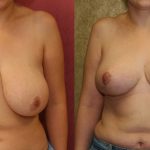 Breast Enhancement Before & After Patient #10502