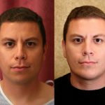 Facial Cosmetic Surgery Before & After Patient #10461