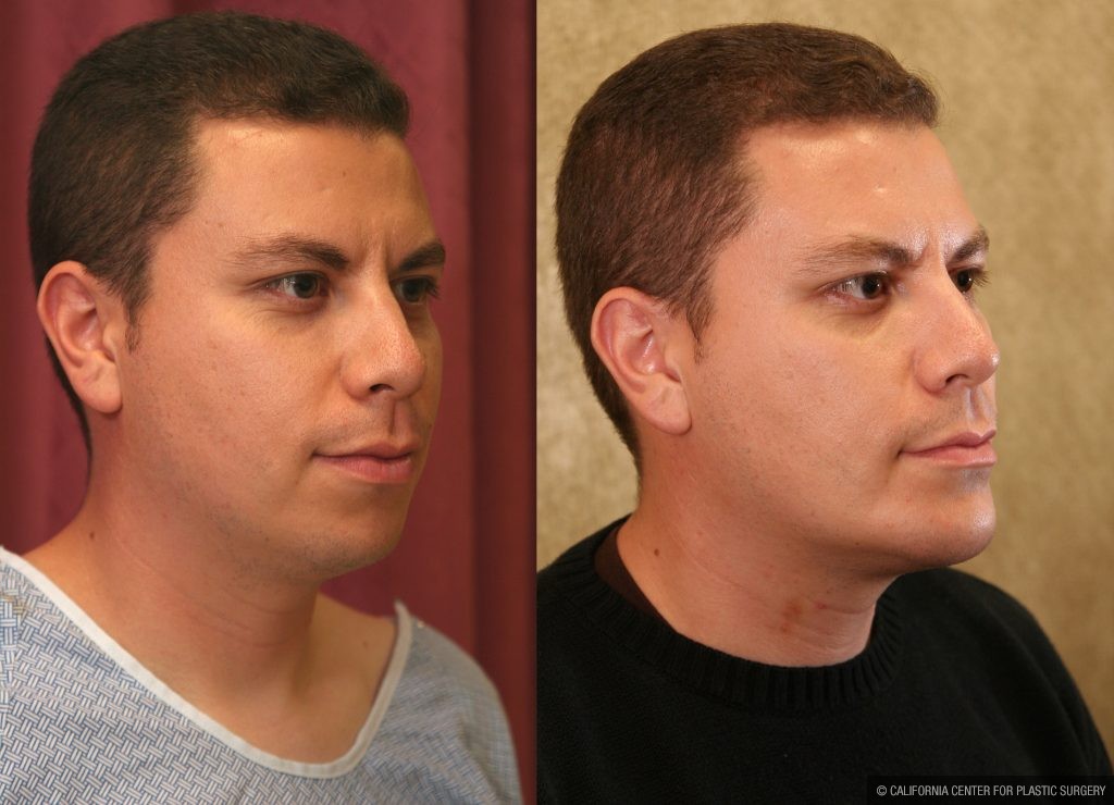 Facial Cosmetic Surgery Before & After Patient #10461