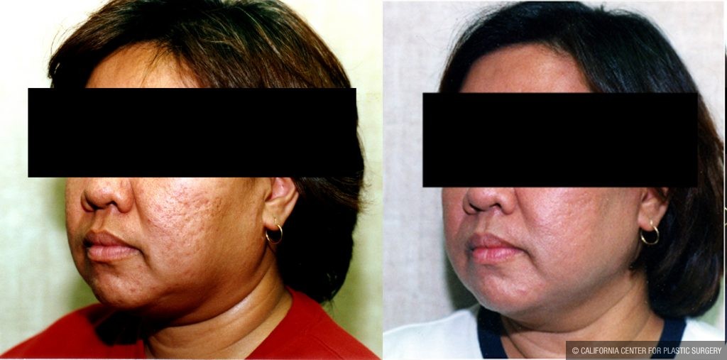 Facial Cosmetic Surgery Before & After Patient #10486