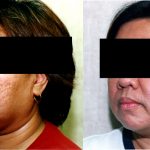 Facial Cosmetic Surgery Before & After Patient #10486