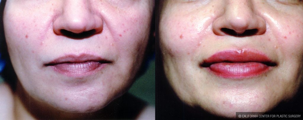 Facial Cosmetic Surgery Before & After Patient #10472