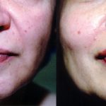 Facial Cosmetic Surgery Before & After Patient #10472