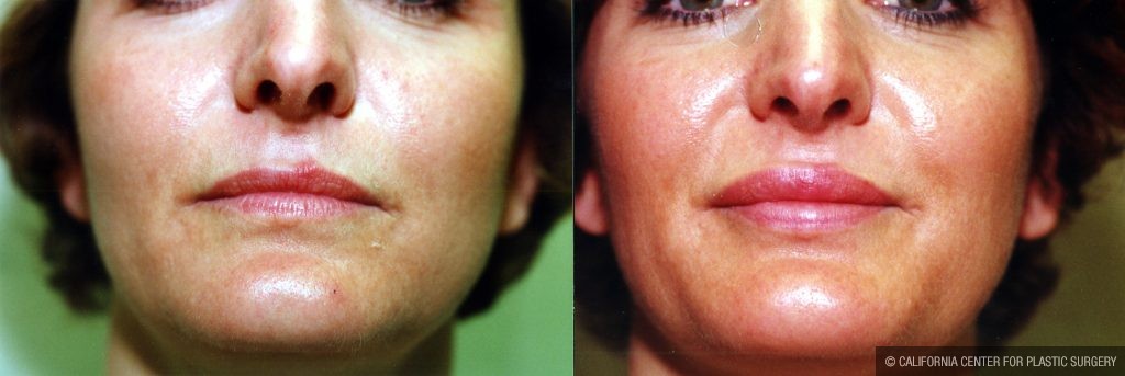 Facial Cosmetic Surgery Before & After Patient #10476