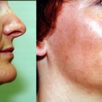 Facial Cosmetic Surgery Before & After Patient #10476